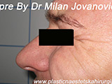 Before Botox Before Botox