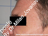 After Botox After Botox