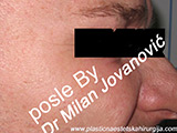 After Botox After Botox