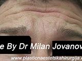 Before Botox Before Botox