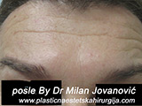 After Botox After Botox