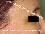 After Botox After Botox