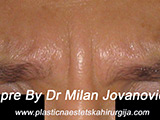 Before Botox Before Botox