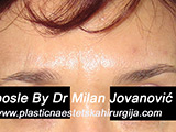After Botox After Botox