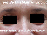 Before Botox Before Botox