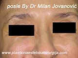 After Botox After Botox