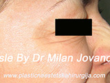 After Botox After Botox