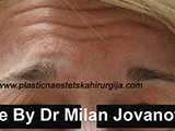 Before Botox Before Botox