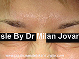 After Botox After Botox