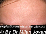 After Botox After Botox