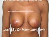 After breast augmentation After breast augmentation