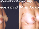 Before and after breast augmentation Before and after breast augmentation