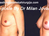 Before and after breast augmentation Before and after breast augmentation