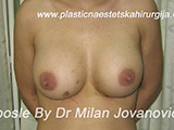 After breast augmentation After breast augmentation