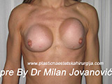 Before breast augmentation Before breast augmentation