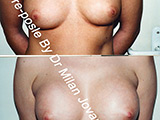 Before and after breast augmentation Before and after breast augmentation
