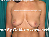 Before breast augmentation Before breast augmentation