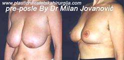 Before breast reduction | After four months Before breast reduction | After four months