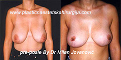 Before breast reduction | After four months Before breast reduction | After four months