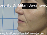 Before face chemical peel Before face chemical peel