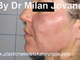 Face chemical peel after one day Face chemical peel after one day