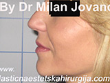 Face chemical peel after ten days Face chemical peel after ten days