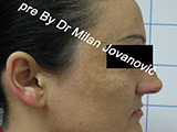 Before face chemical peel Before face chemical peel
