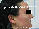 Face chemical peel after two days Face chemical peel after two days