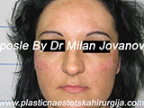 Face chemical peel after seven days Face chemical peel after seven days