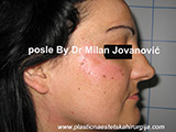 Face chemical peel after seven days Face chemical peel after seven days