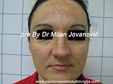 Before face chemical peel Before face chemical peel