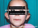 Before ear surgery Before ear surgery