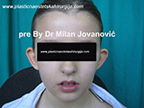 Before ear surgery Before ear surgery