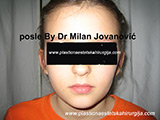 After ear surgery After ear surgery