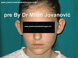 Before ear surgery Before ear surgery