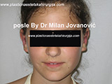 After ear surgery After ear surgery