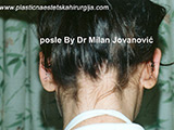After ear surgery After ear surgery