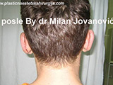 After ear surgery After ear surgery