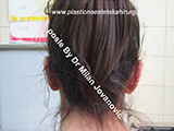 After ear surgery After ear surgery