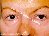Before eyelid surgery