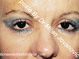 After eyelid surgery