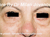 Before eyelid surgery