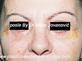 After eyelid surgery
