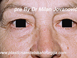 Before eyelid surgery