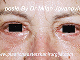 After eyelid surgery