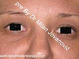 Before eyelid surgery