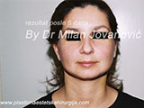 Five days after face lift