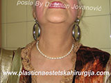 After face lift