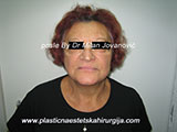 After face lift