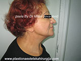 After face lift